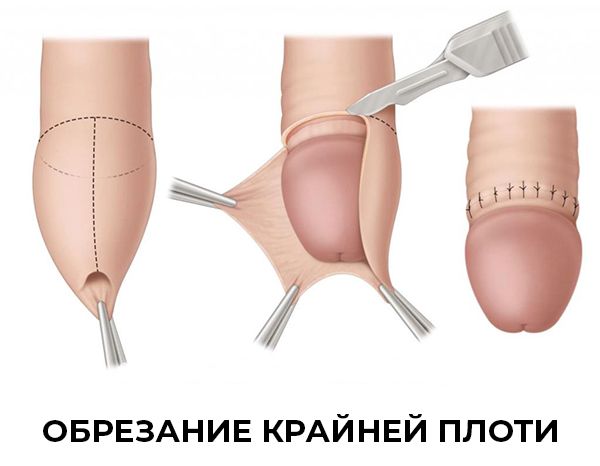 Сделать обрезание в Краснодаре. Клиника УРО-ПРО