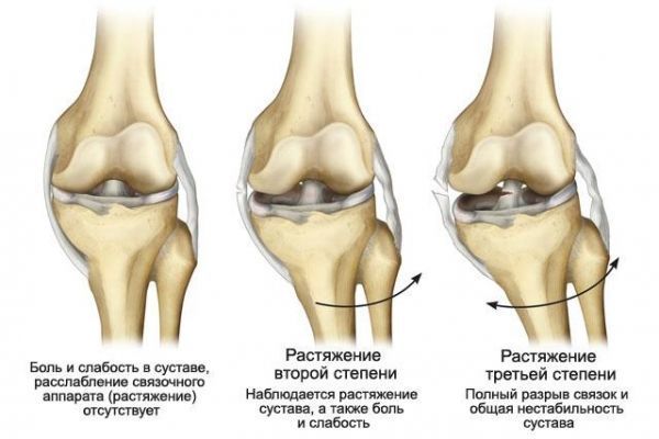 Травмы коленного сустава