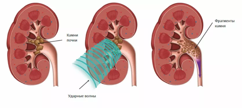 Свищи прямой кишки