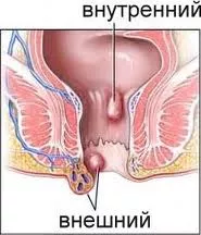 Нарушение стула при геморрое