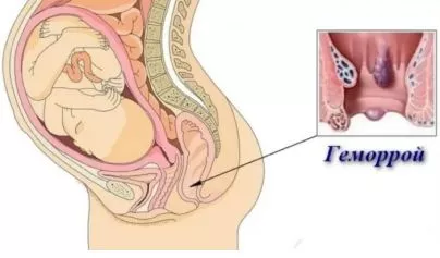 Геморрой при беременности: признаки, симптомы, лечение, чем опасен, как избежать