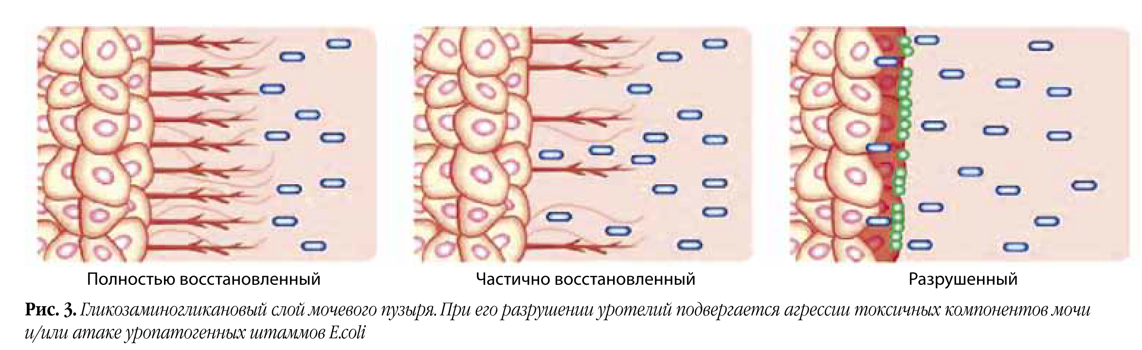 Хронический цистит - Терапия