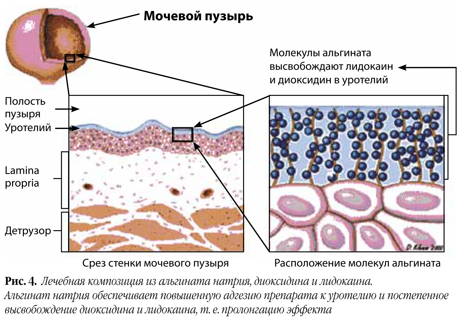 Хронический цистит - Терапия