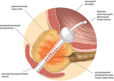 Трансуретральная термотерапия простатита последствия thumbnail